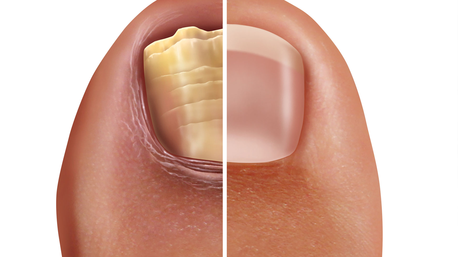 Ingrown toenail? How to snip it the right way | Fox News